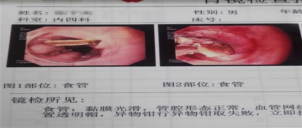 有鲠在喉  不吐不快——内镜下治疗食管、胃异物钳夹取出术
